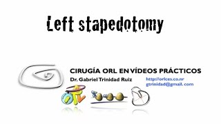 STAPEDOTOMY PLACING THE PROSTHESIS AFTER EXTRACTING THE STAPES - Dr. Gabriel Trinidad Ruiz