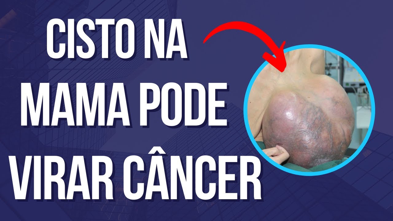 CISTO NA MAMA PODE VIRAR CÂNCER