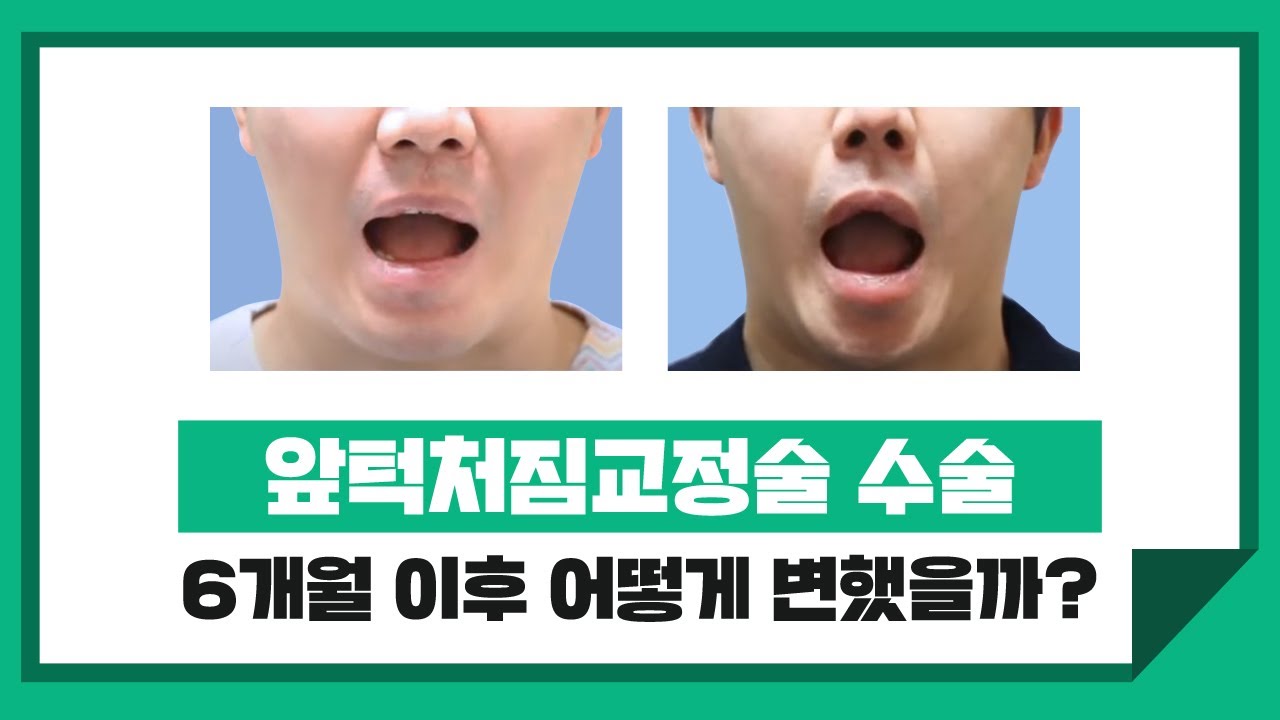앞턱처짐교정술(Mentalis Resuspension) 사례연구  썸네일