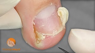 Ingrown, spicules, onychomycosis and blister | Toenail cleaning | Podological treatment