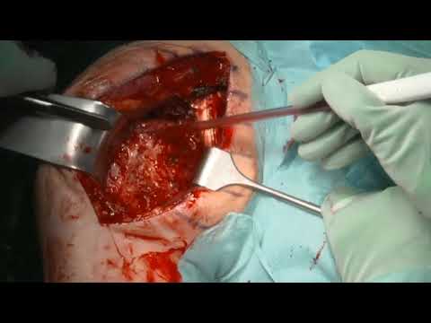 MO.S.A.I.C. 2024 - Live Surgery: RSA (complex glenoid reconstruction) - ProMade