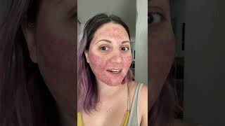 Láser co2 fraccionado #laserco2 #laserco2machine