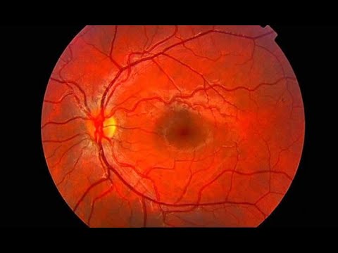 Ocular macula, what is it and what is its function? - Dr. Gallego Pinazo