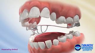 How a Tongue Crib Appliance Can Help