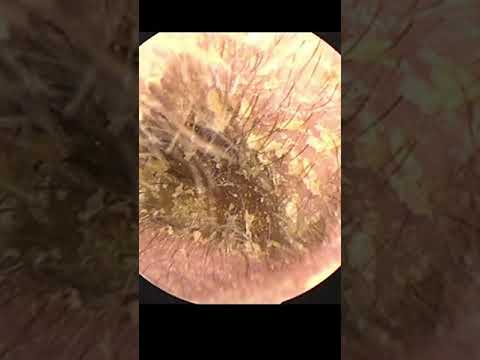 EAR WAX REMOVAL #Shorts #094