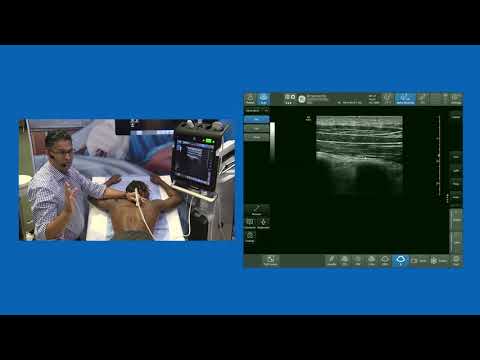 Erector Spine Plane (ESP) block - Live Demo
