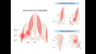 Understanding Snapping Hip Syndrome - Why Your Hip Clicks, Pops, or Snaps