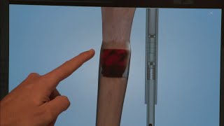 People with leg length discrepancy being given new approach for help