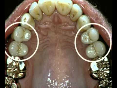 Металлокерамические коронки в Донаре вита