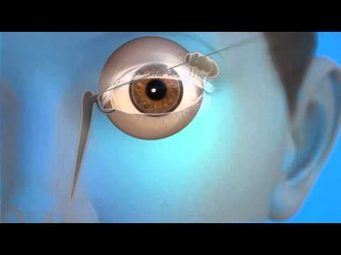 Tear Duct Probing Surgery