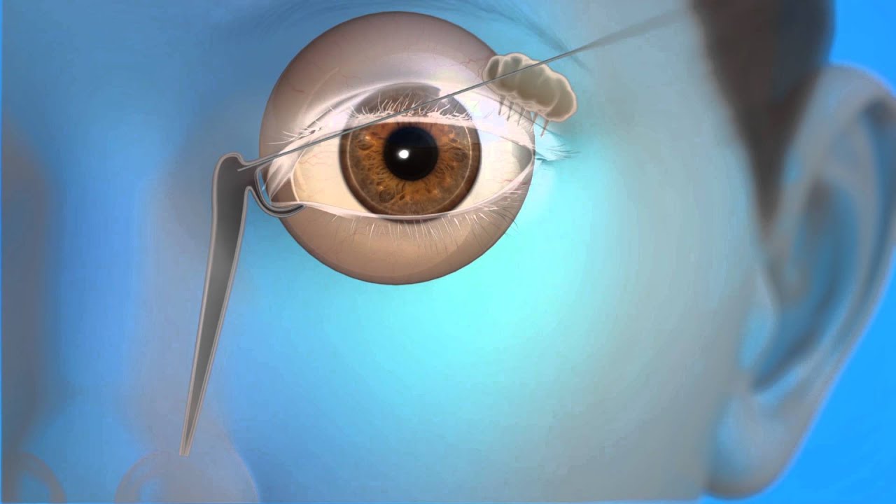 Tear Duct Probing Surgery
