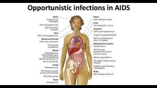 Opportunistic Infections in HIV and AIDs