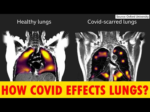 How Does COVID Affect the Lungs | Tested Xenon Gas | COVID Lungs Report | Health Series