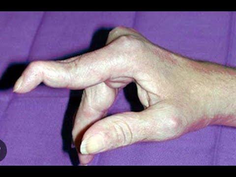 Finger Splint Recommendations