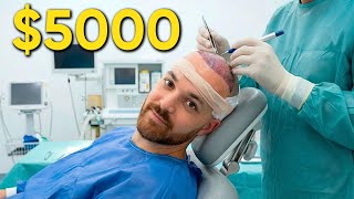 My Hair Transplant Experience in Turkey (Raw and Unfiltered)