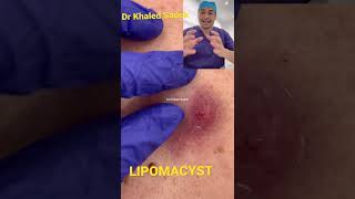 What’s infected? #shorts #blackheads #cystremoval #pimple Dr Khaled Sadek