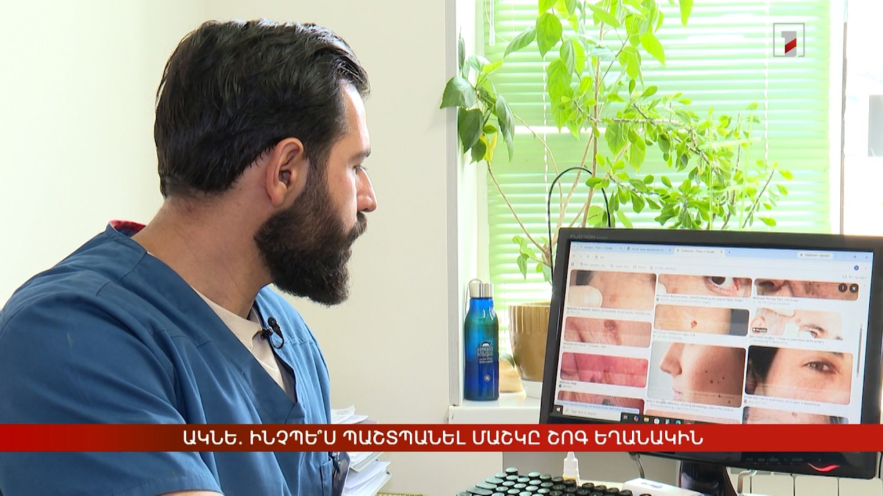 Ակնե. ինչպե՞ս պաշտպանել մաշկը շոգ եղանակին