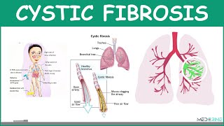 Cystic Fibrosis Explained: Causes, Symptoms, Diagnosis & Treatment | Nursing & Medical Overview