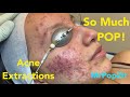 So Much Pop Acne Extractions On Severe Inflammatory Acne Multiple Blackheads And Whiteheads