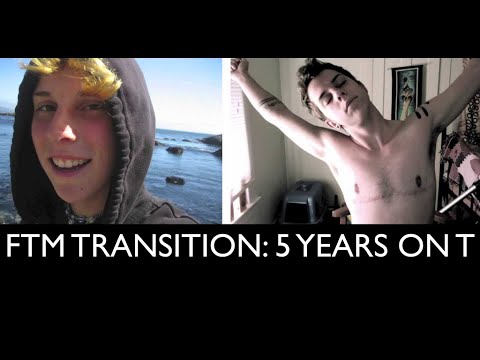 FTM Transition: 5 Years on Testosterone Picture/Timeline