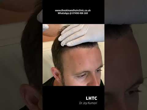 UK Hair Transplant - 6 Months Results Full head - Dr Kumari @liverpoolhairtransplantcli3720