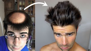 How My Hair Grew Back Double - After losing it?