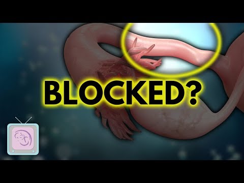 Blocked Tubes How to Avoid IVF and Surgery Fertility Expert Dr Randy Morris