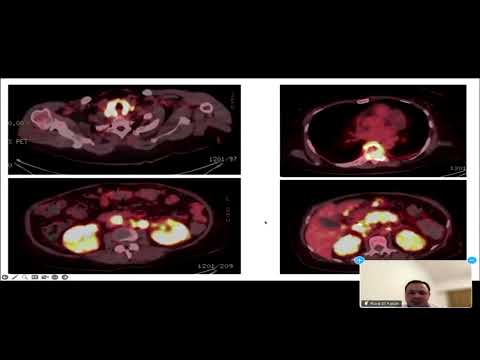 04 LBCL Case Presentation | Dr. Riad Elfakih | 25 Oct 2024