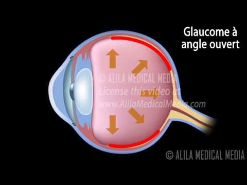 Crise hypertensive 26 ans Stade de lhypertension 2 du risque au 2e degré