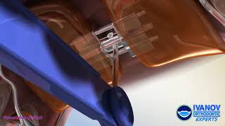 Fix Crowding with Haas Expander