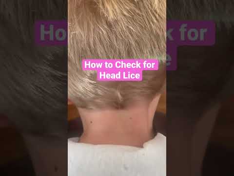 How to Check for Head Lice on Boys l Lice Infestation l Lice Removal Service