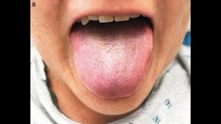 What is "black hairy tongue"?