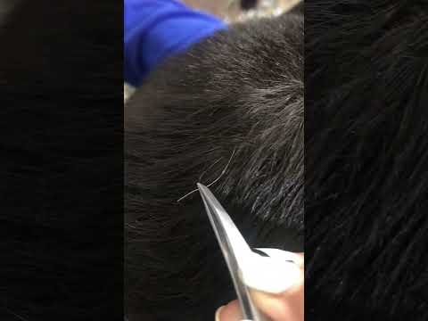 White hair removal