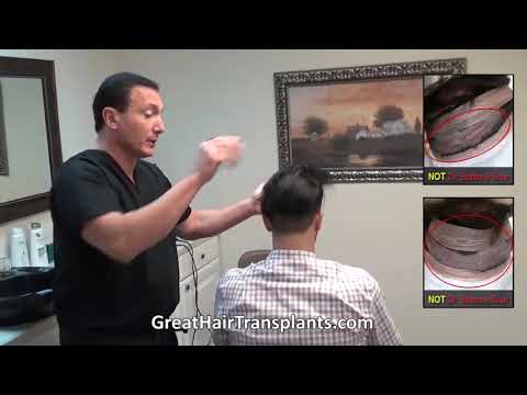 Dr. Brett Bolton patient Andy MaxHarvest&trade; and Scar Revision



