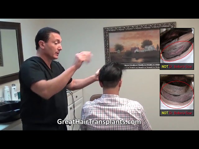 Dr. Brett Bolton patient Andy MaxHarvest&trade; and Scar Revision



