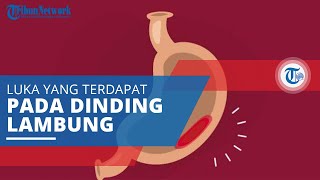 Tukak Lambung, Luka yang Muncul pada Dinding Lambung sebab Terkikisnya Lapisan Dinding Lambung