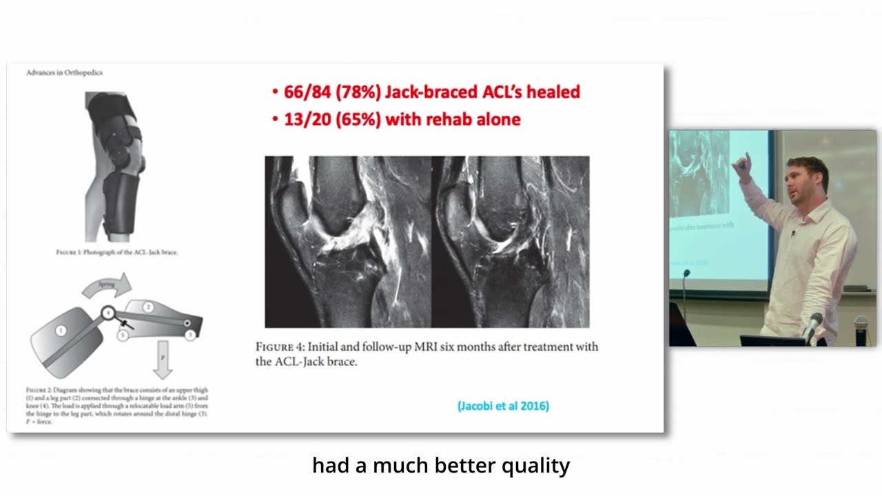 'ACL tears can heal without surgery: The game has changed' 15-minute preview