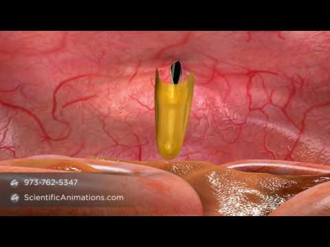 Inguinal Hernia Mesh   3D Medical Animation