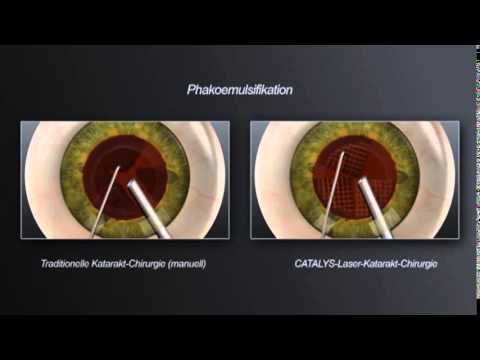 Informationsvideo zur Operation des Grauen Stars mit Laser