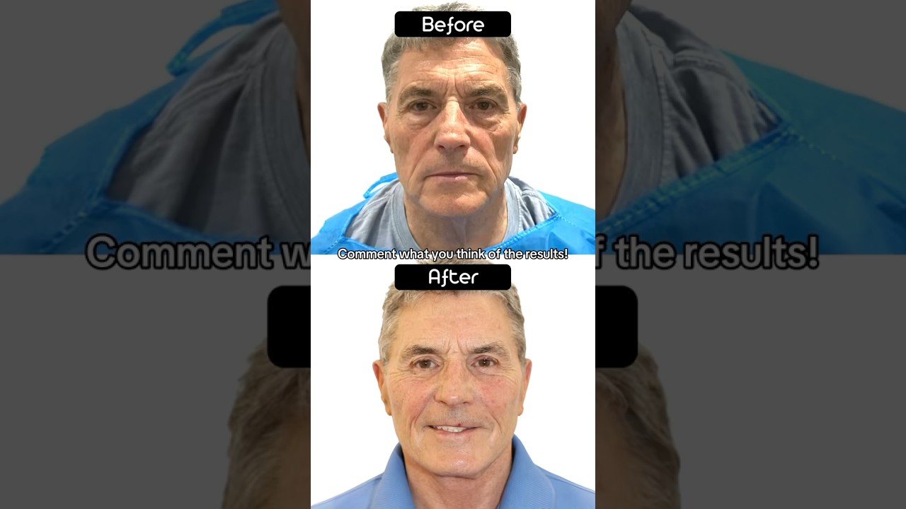 6 Week Male Face & Neck Lift Amazing Transformation! - 20 Years Younger!