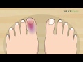 How To Know If Your Toe Is Broken