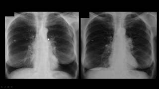 Região Peri Hilar Pulmão