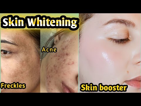Get Rid of Freckles, Acne,,Dark Spots,,NATURALLY Fade Away Hyperpigmentation and Get FLAWLESS Skin!