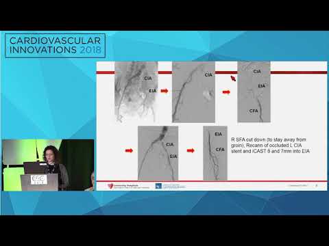 CVI2018 Session: Common femoral and aortoiliac disease - hybrid approach - Karem Harth, MD