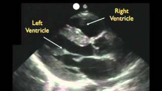 Cardiac Ultrasound - Parasternal Long Axis - Part 1 - SonoSite, Inc.