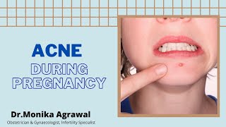 Acne in Pregnancy | Dr Monika Agrawal