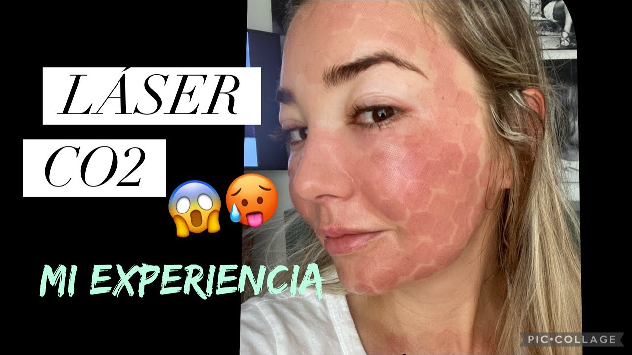 Watch TODO SOBRE EL LASER FRACCIONADO | PIEL DE BEBE | ALEJA FRANCO Now TODO SOBRE EL LASER FRACCIONADO | PIEL DE BEBE | ALEJA FRANCO