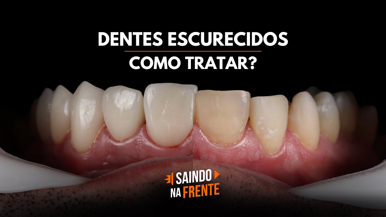 Dentes escurecidos: como tratar?