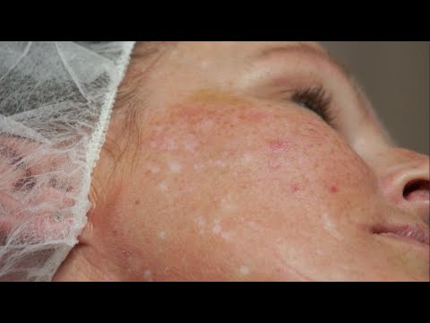 Snazll cinese che candeggia risposte alla panna Posti di pigmentary e sole
