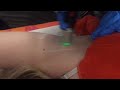 Painless Laser Hair Removal of Arm Pit using the Motus AY Laser at Reading Cosmetic Laser